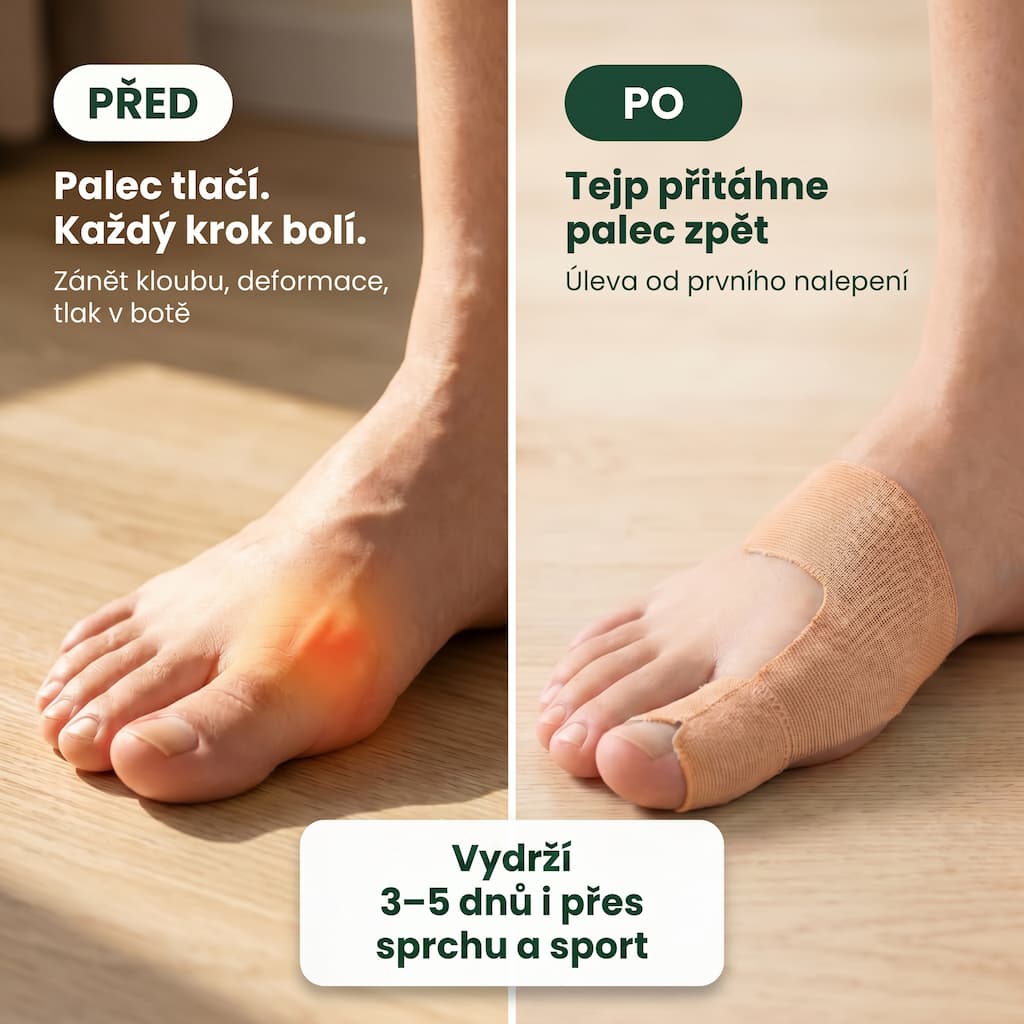 Tejpy na hallux valgus před a po – přitažení palce zpět